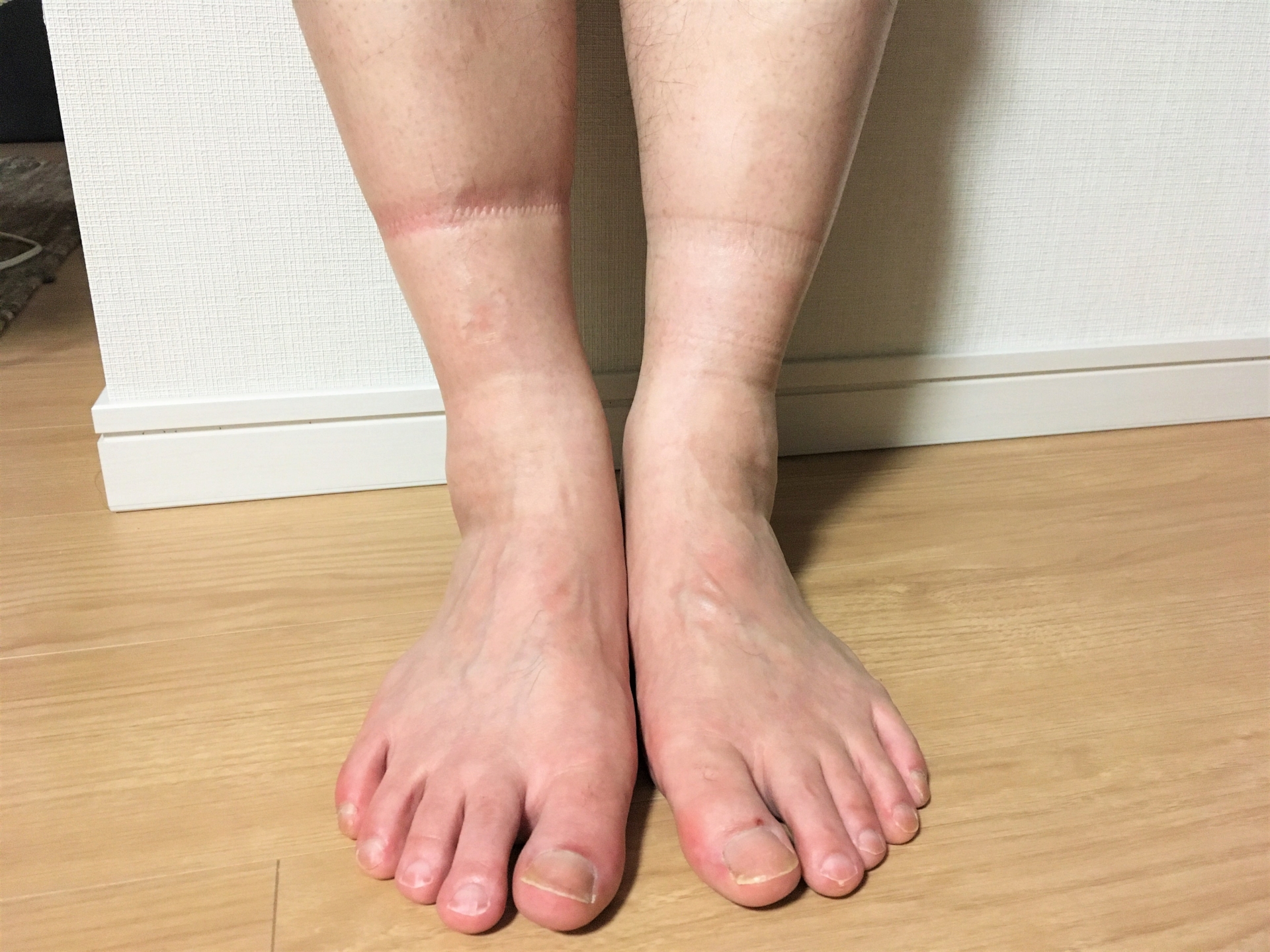 「O脚はむくみの原因にも！」スッキリ美脚を手に入れる方法【堺市 O脚】